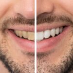 The Secret to a Whiter Smile: Teeth Whitening Explained